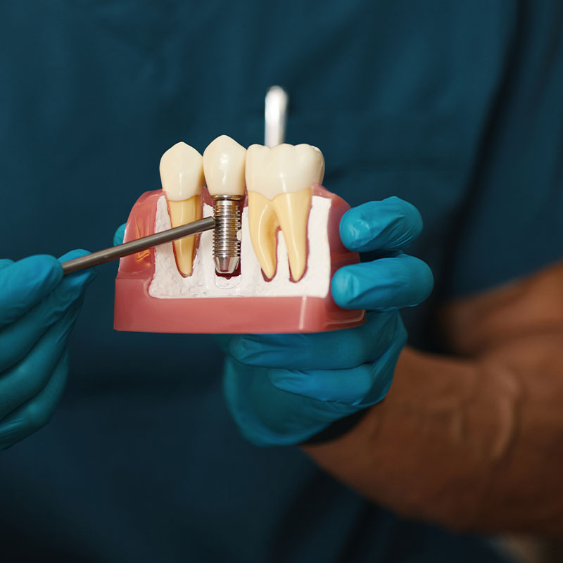 Buck Dental Health Associates | Inlays  amp  Onlays, Veneers and Juvederm reg